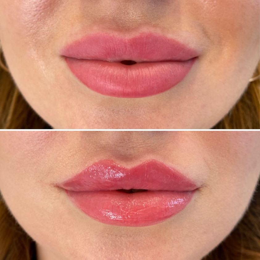 Cameo Clinic Lip Augmentation After-Effect