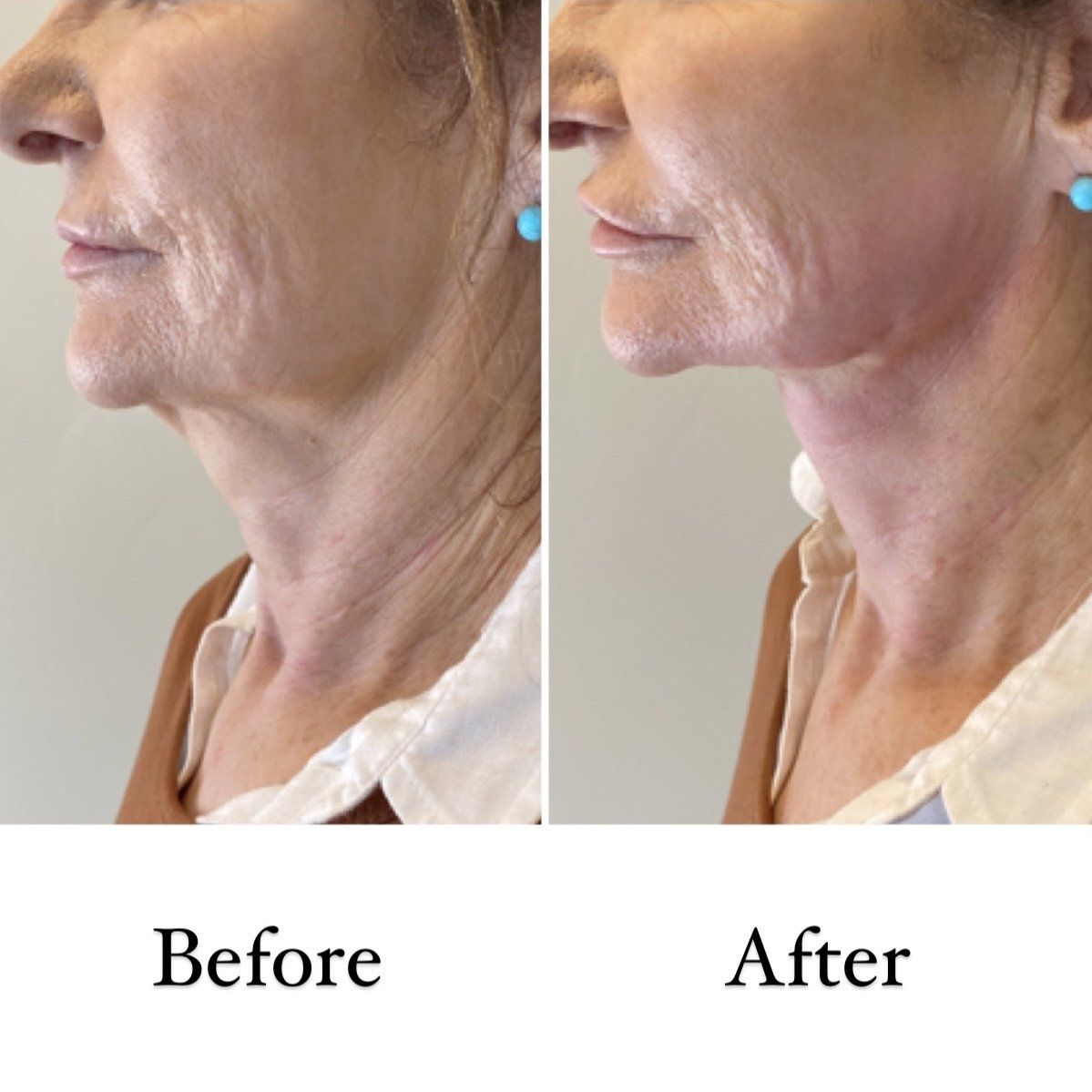 Cameo Clinic jawline/double chin thread lift before & After