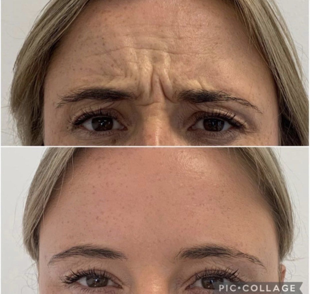 Cameo Clinic anti wrinkle injections before & After