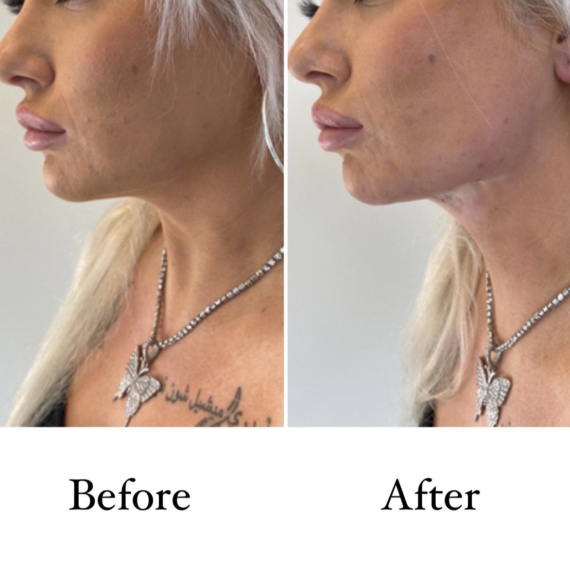 Cameo Clinic jawline/double chin thread lift before & after