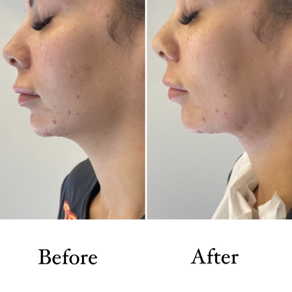Cameo Clinic jawline/double chin thread lift before & after