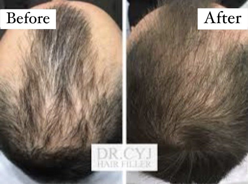 Cameo Clinic Dr. CYJ Hair Filler After-Effect