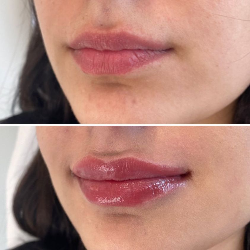 Cameo Clinic Lip Augmentation Befor & After