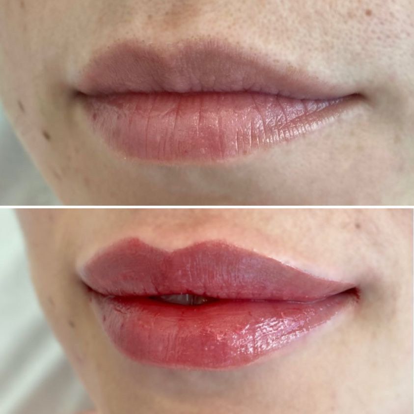 Cameo Clinic Lip Augmentation Before & After