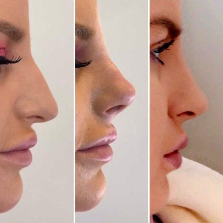 Cameo Clinic nose thread lift before & after