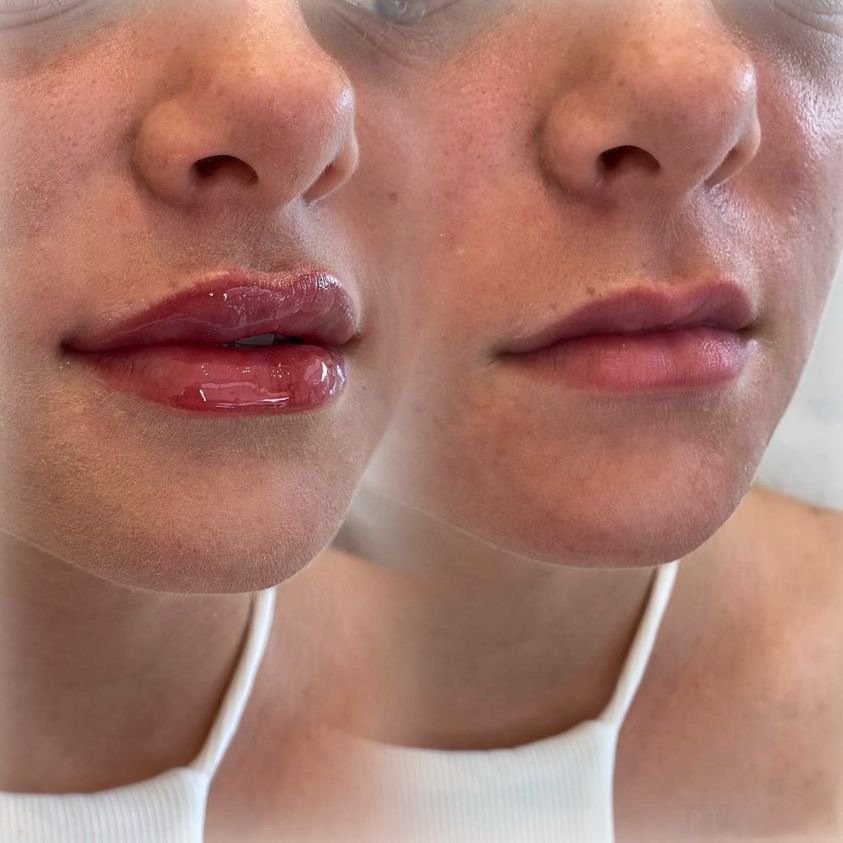 Cameo Clinic Lip Augmentation Befor & After