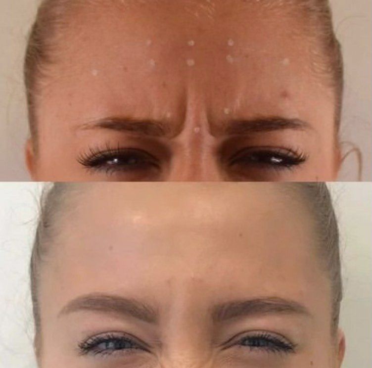Cameo Clinic anti wrinkle injections before & after