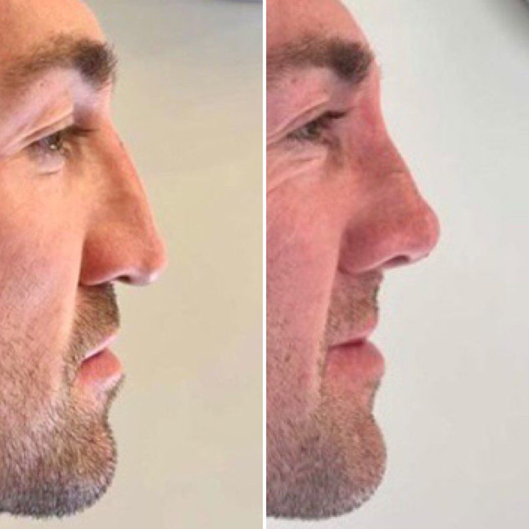 Cameo Clinic nose thread lift before & after