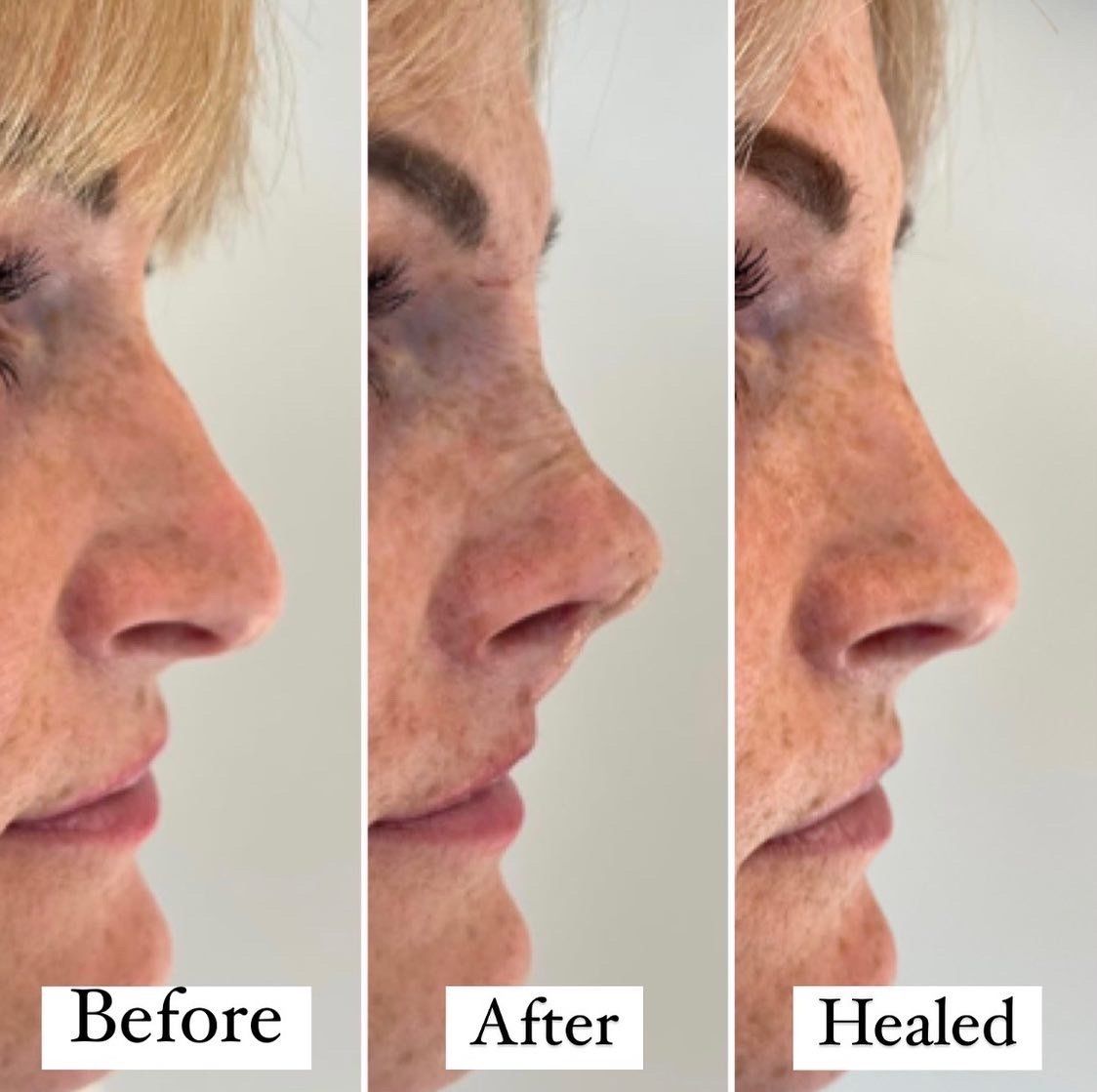 Cameo Clinic nose thread lift before & After