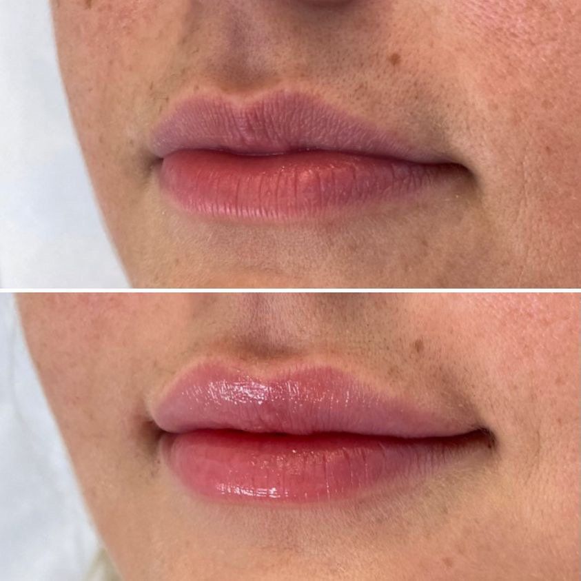 Cameo Clinic lip augmentation before & after