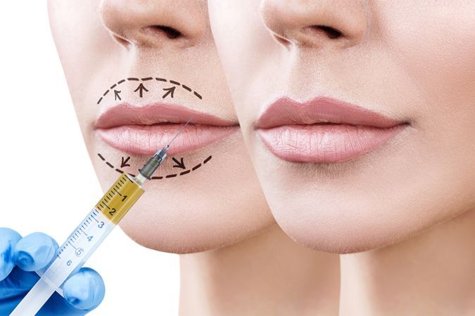Cameo Clinic Lip Augmentation How It Works