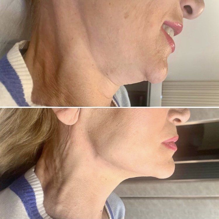 Cameo Clinic Jawline Thread Lift