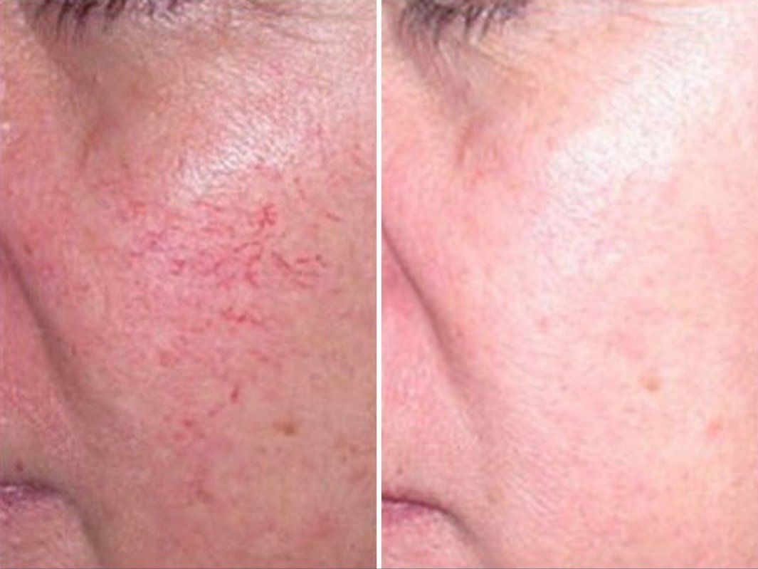 Cameo Clinic Red Vein Before After