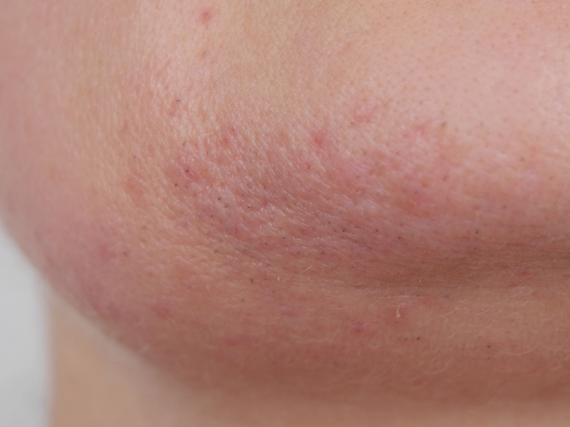 Eine Nahaufnahme vom Gesicht einer Frau mit Akne.