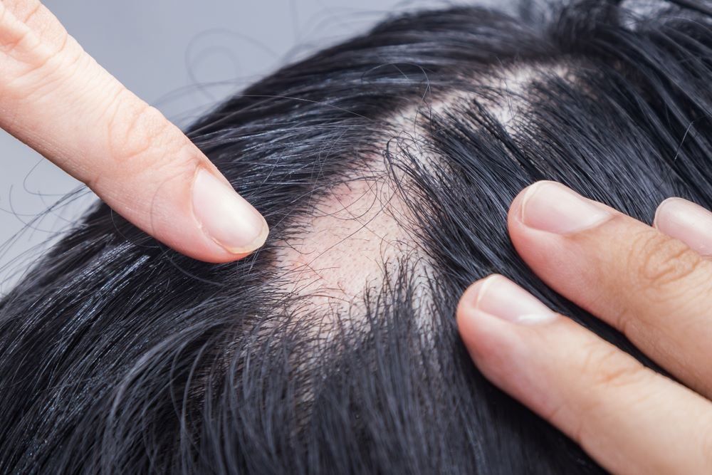 Tratamento para alopecia areata