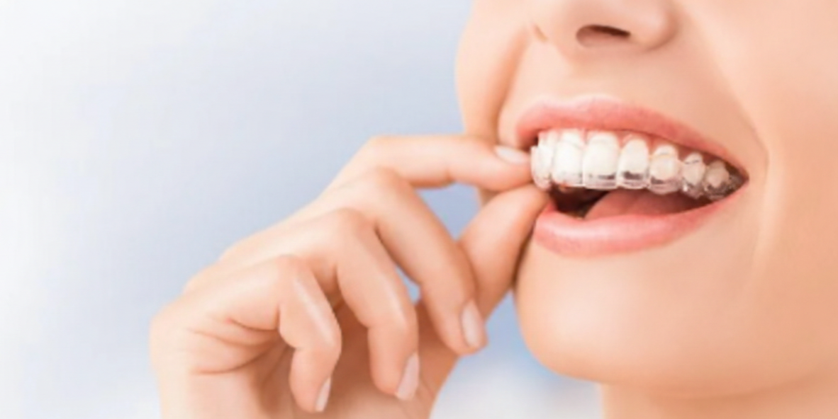 La persona inserisce un allineatore dentale trasparente nella propria bocca.