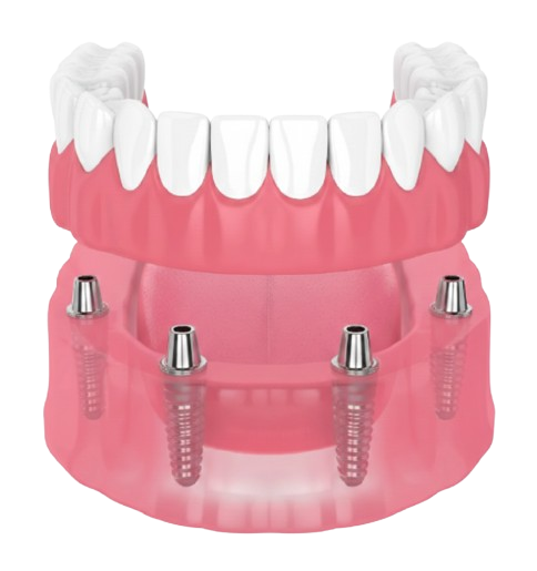 Modello dentale che mostra le protesi dentarie fissate agli impianti dentali.