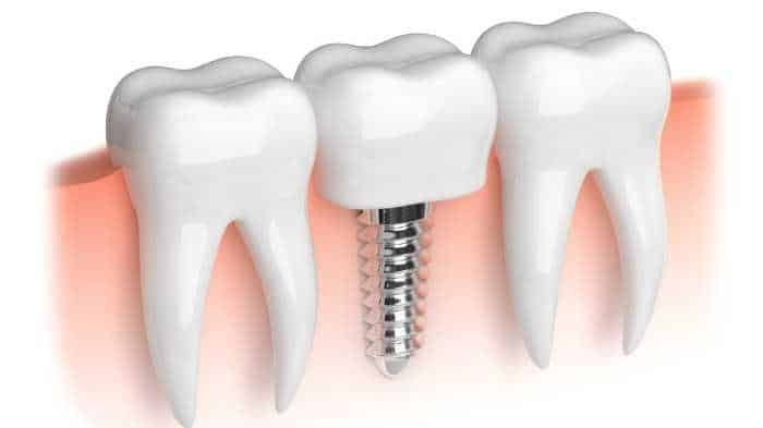 7 Things You Should Know Before Getting Dental Implants