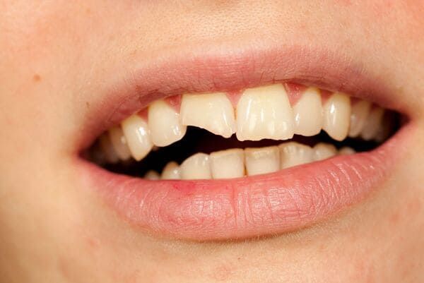 A close up of a person 's mouth with a broken tooth.