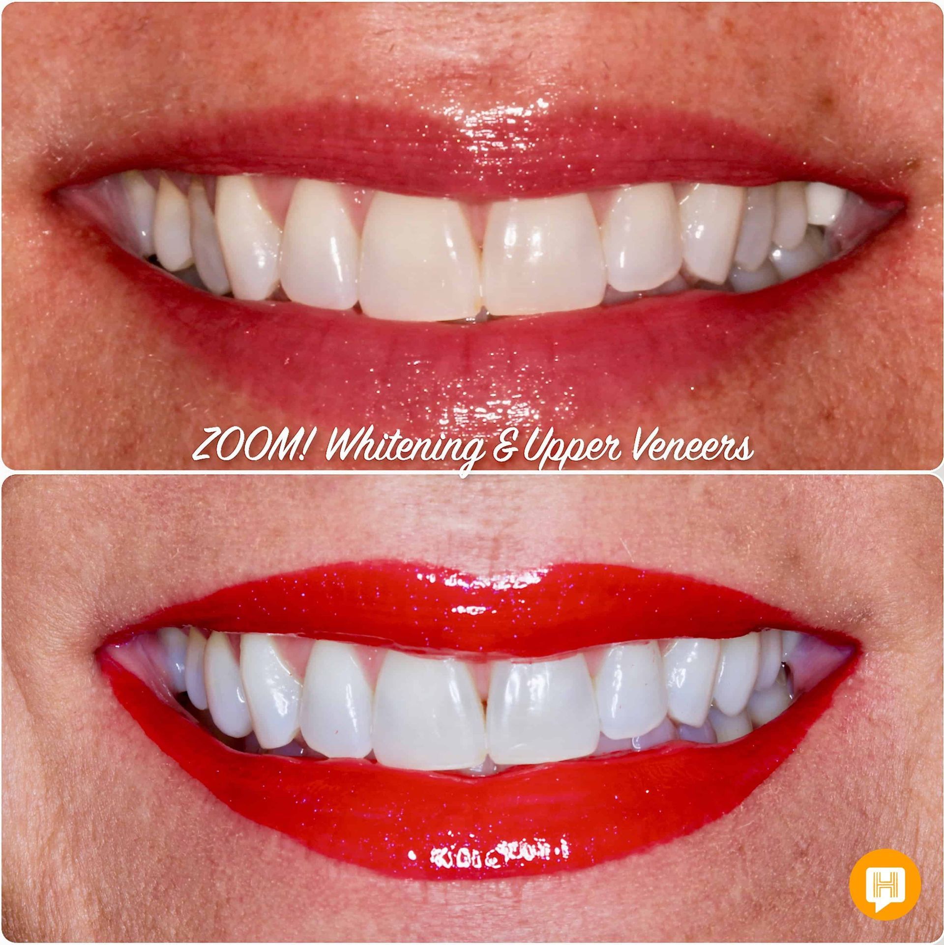 A before and after photo of a woman 's teeth