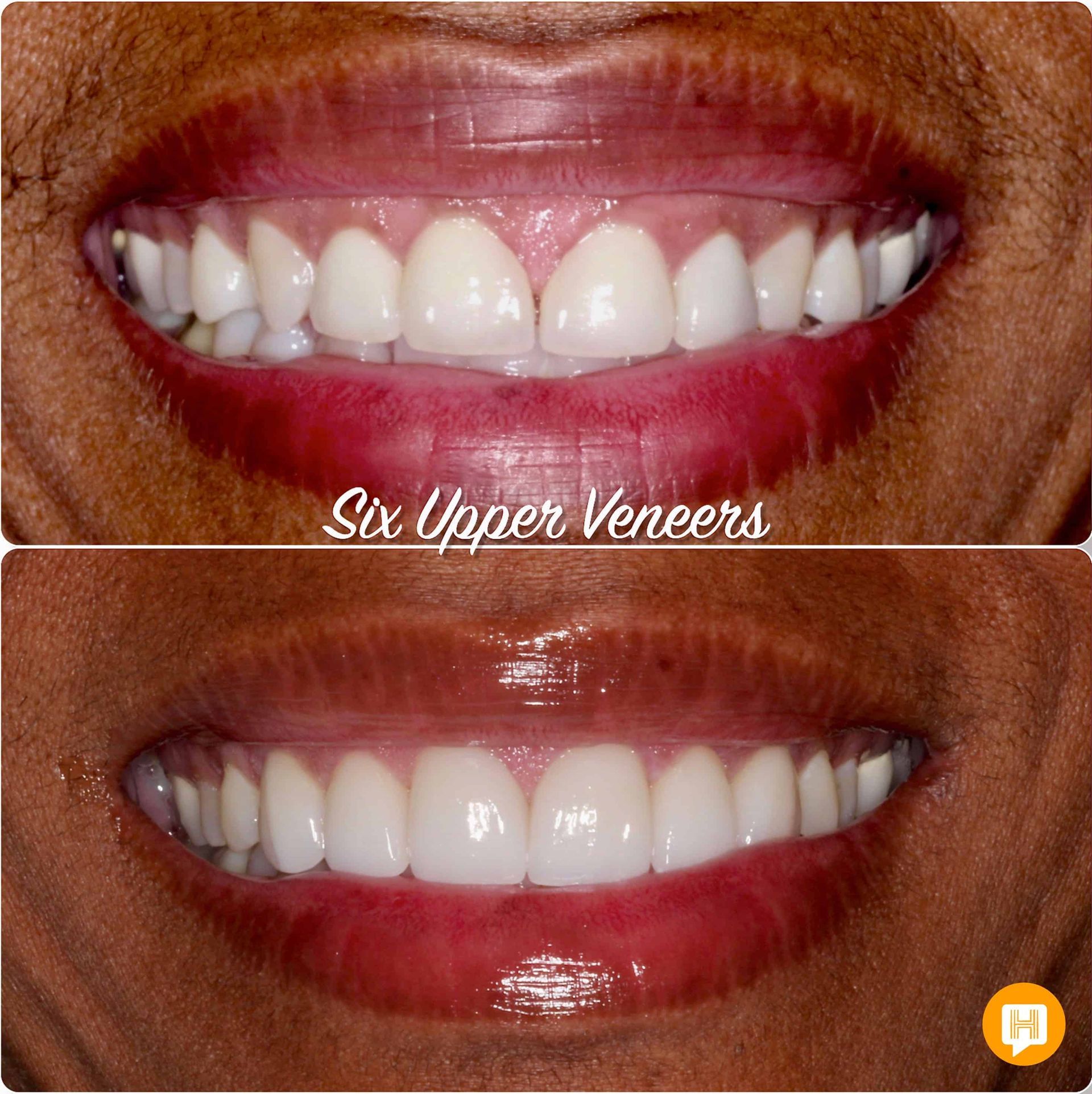 A before and after photo of a woman 's teeth with six upper veneers