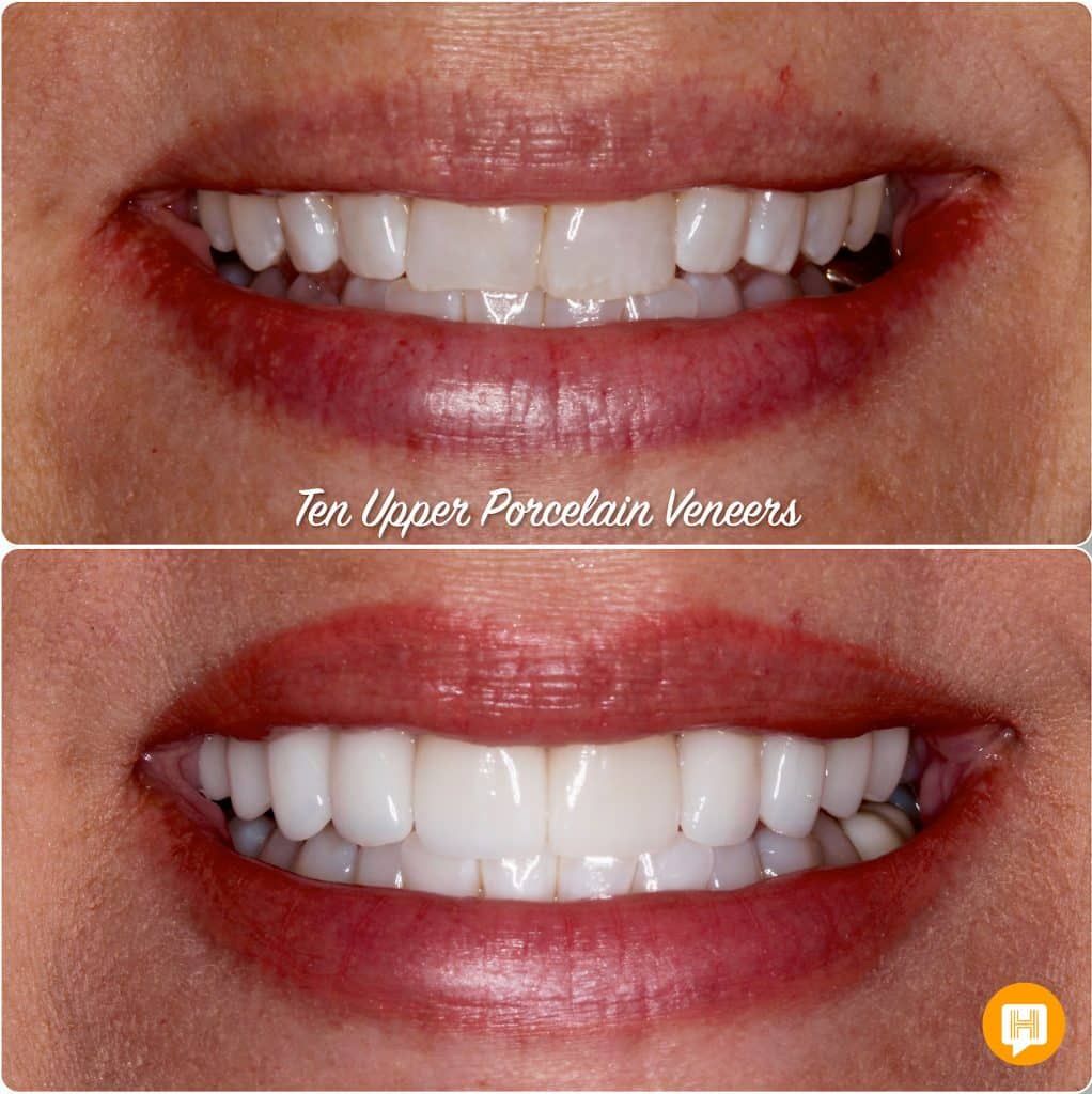 A before and after photo of a woman 's teeth with porcelain veneers.