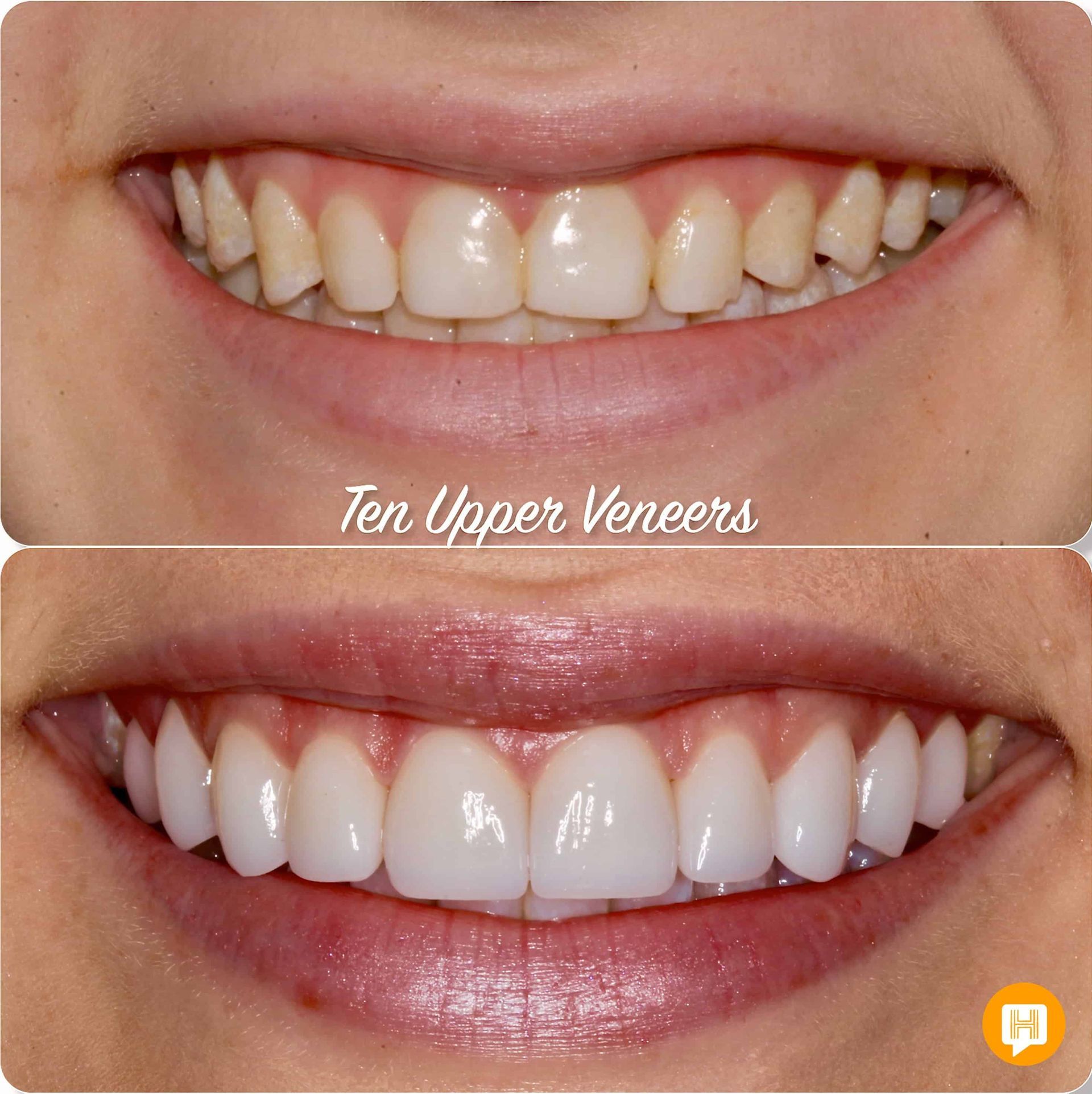 A before and after picture of a woman 's teeth with veneers.