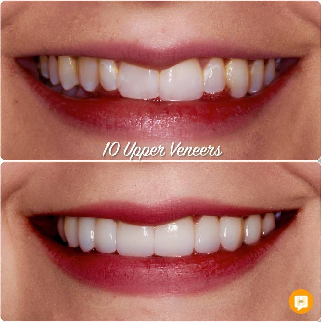 A before and after photo of a woman 's teeth with 10 upper veneers