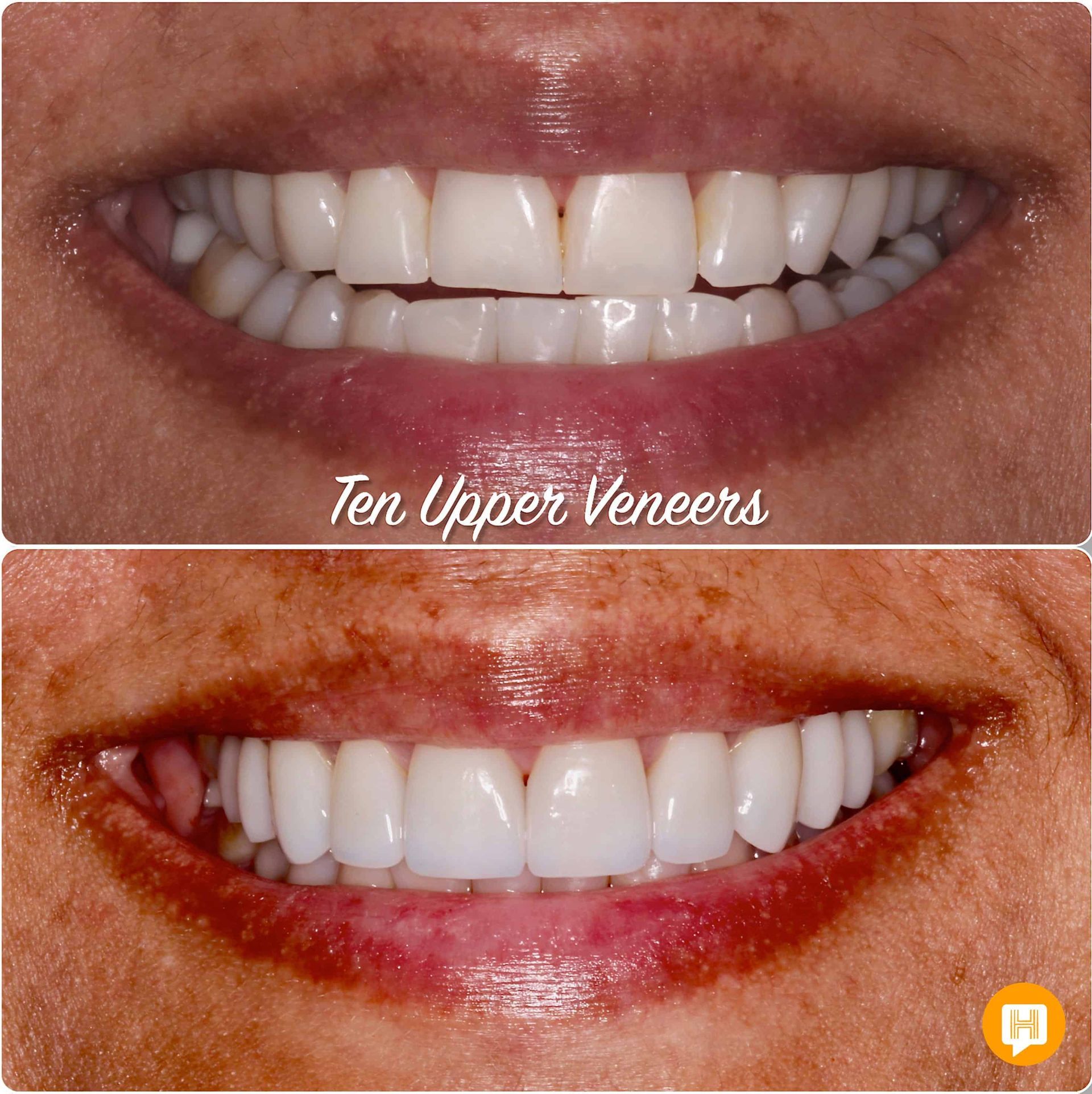 A before and after photo of a woman 's teeth with the caption ten upper veneers