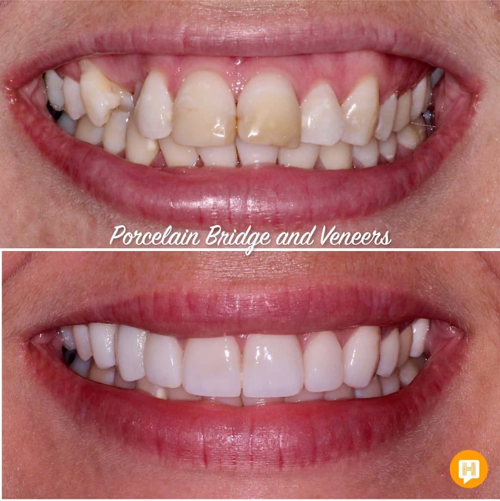 A woman 's teeth before and after porcelain bridge and veneers