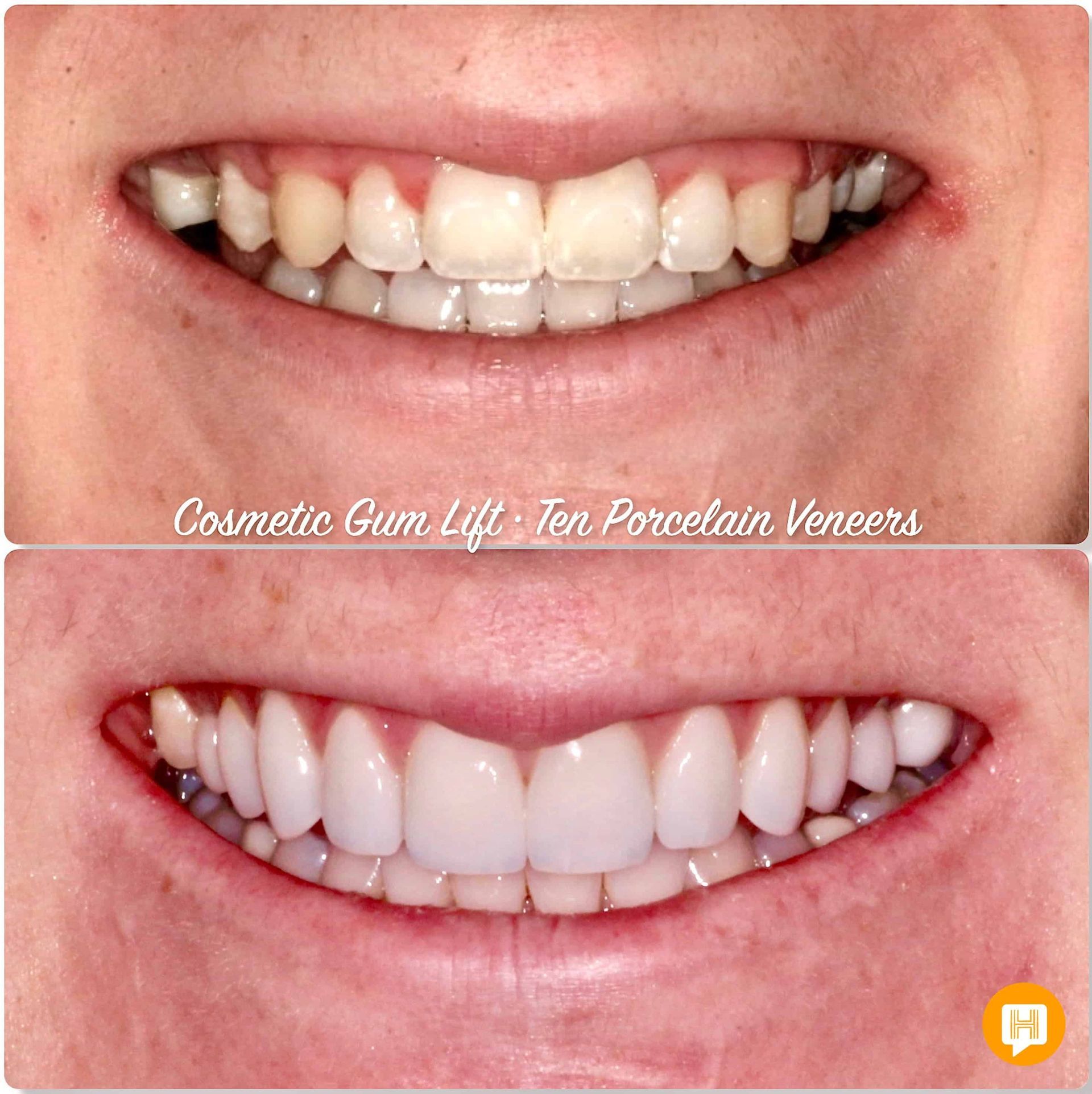 A woman 's teeth before and after cosmetic gum lift