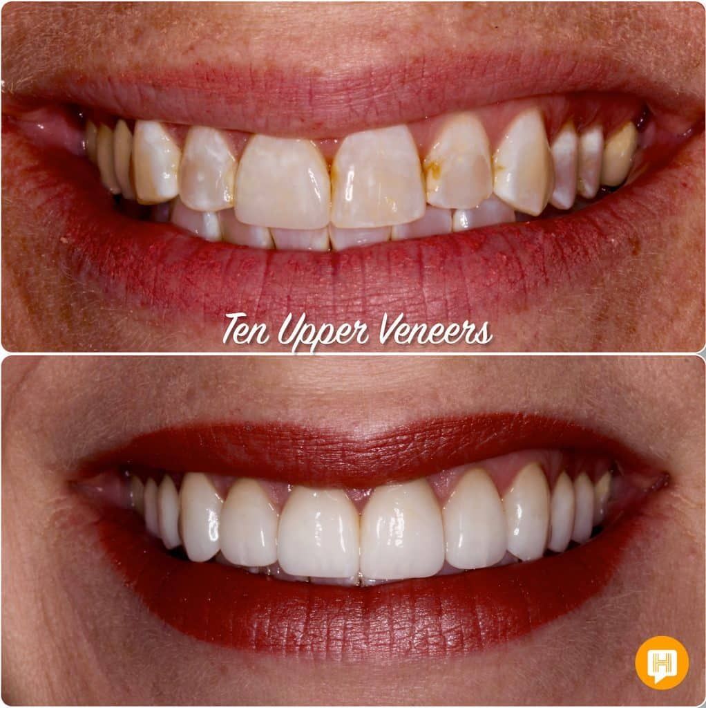 A before and after photo of a woman 's teeth.