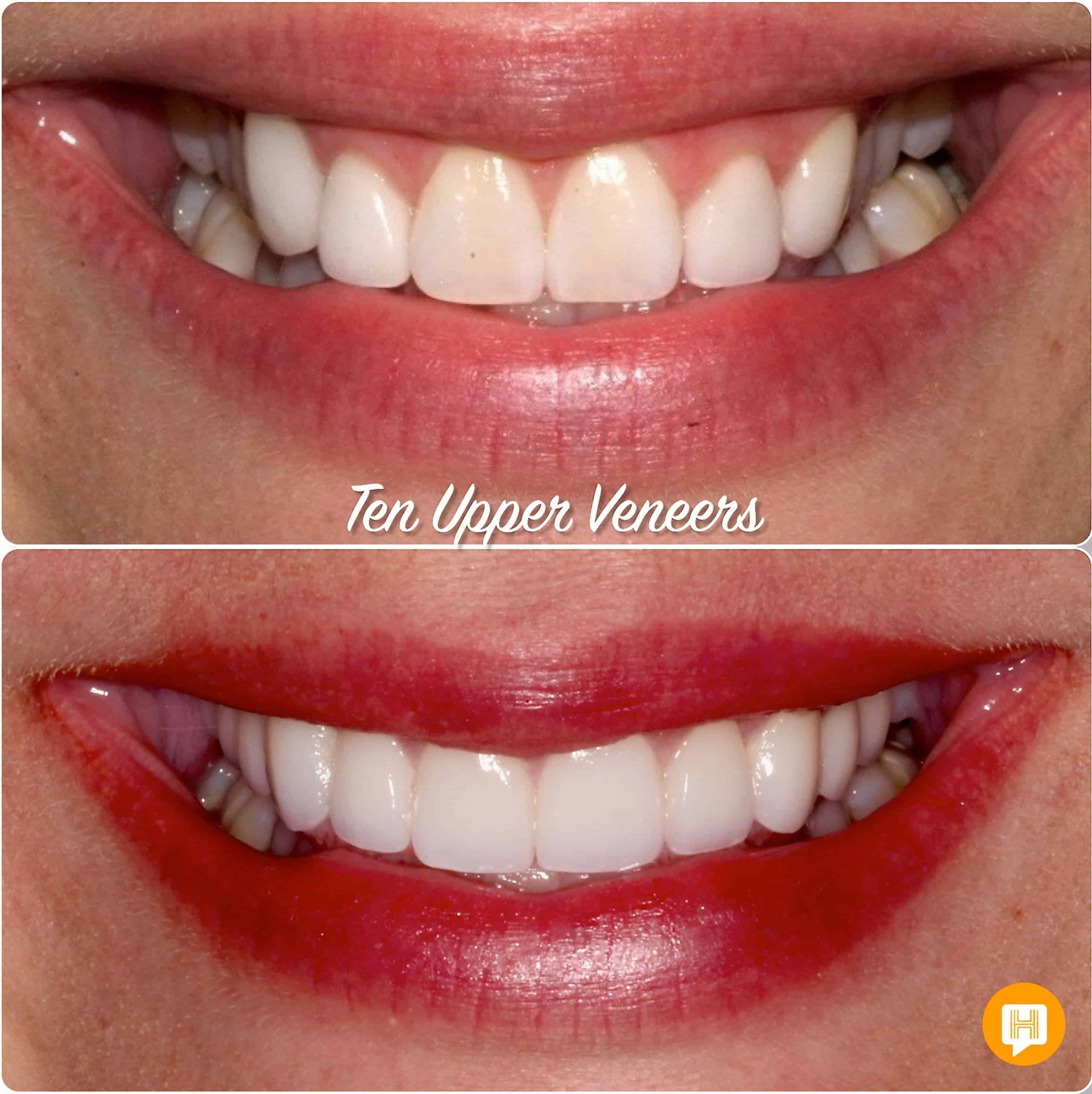 A before and after photo of a woman 's teeth with ten upper veneers