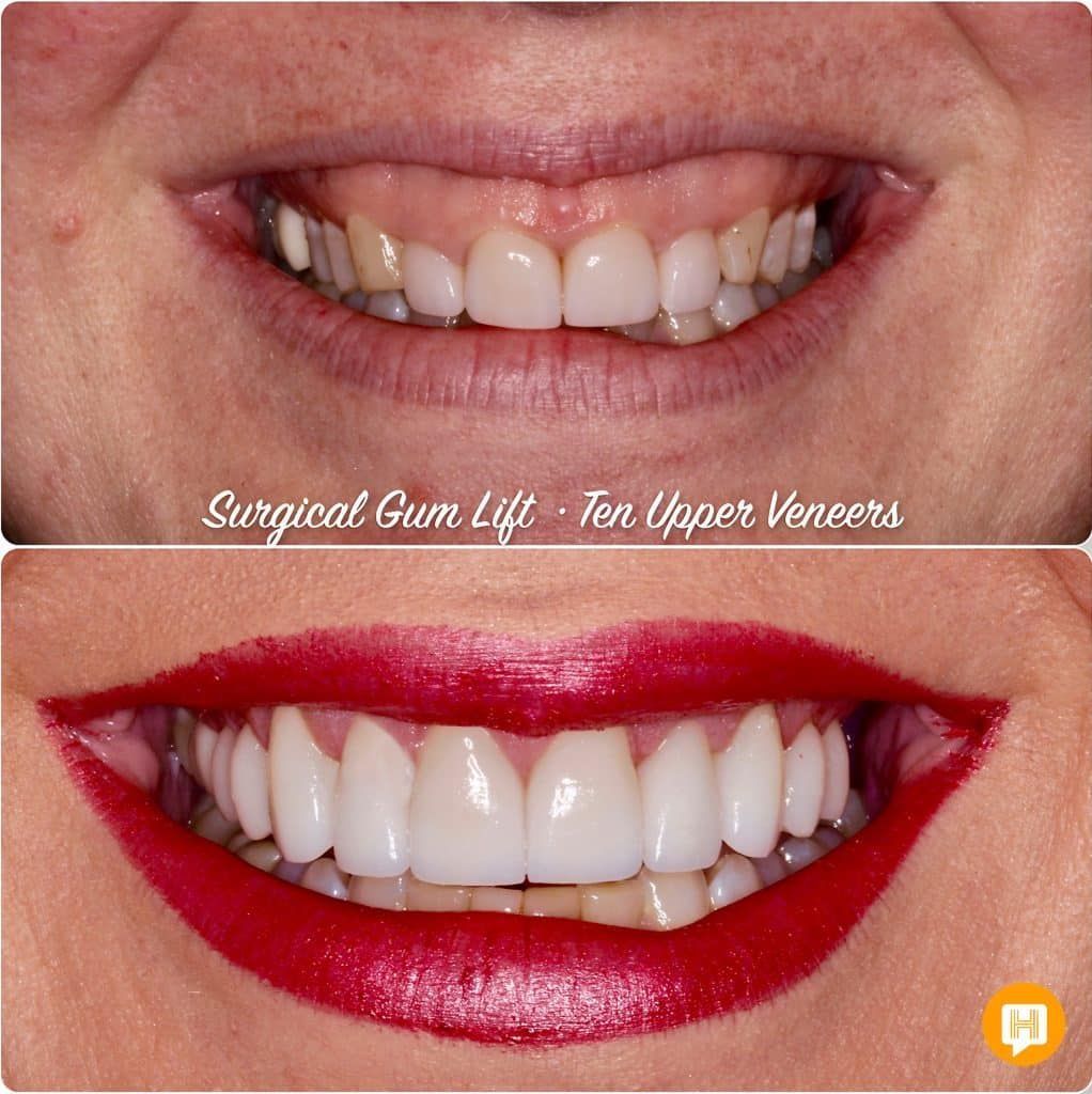 A before and after photo of a woman 's smile with red lipstick.