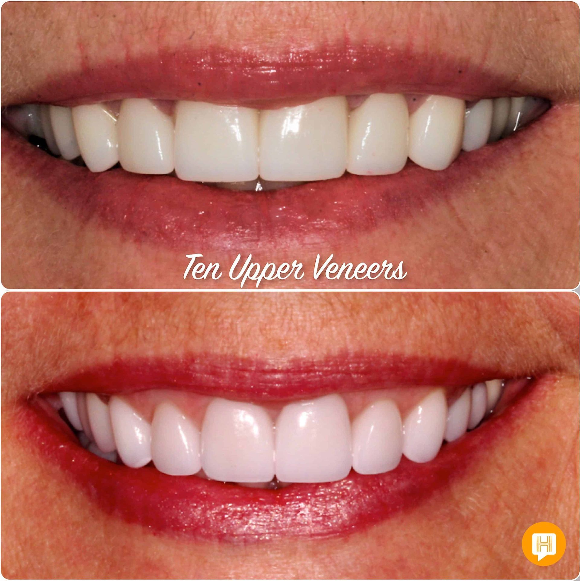 A before and after photo of a woman 's teeth with ten upper veneers