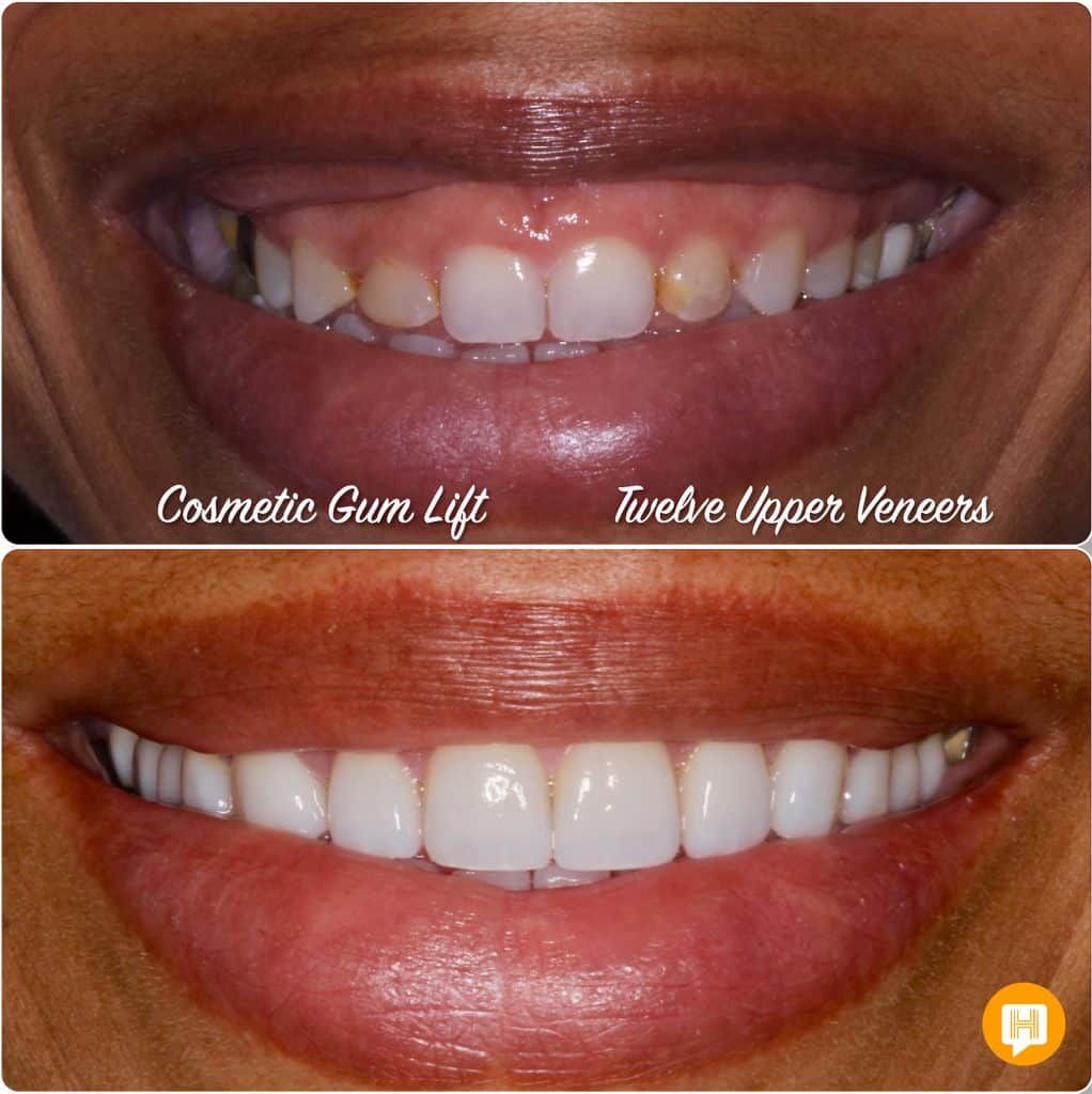 A woman 's teeth before and after cosmetic gum lift and twelve upper veneers