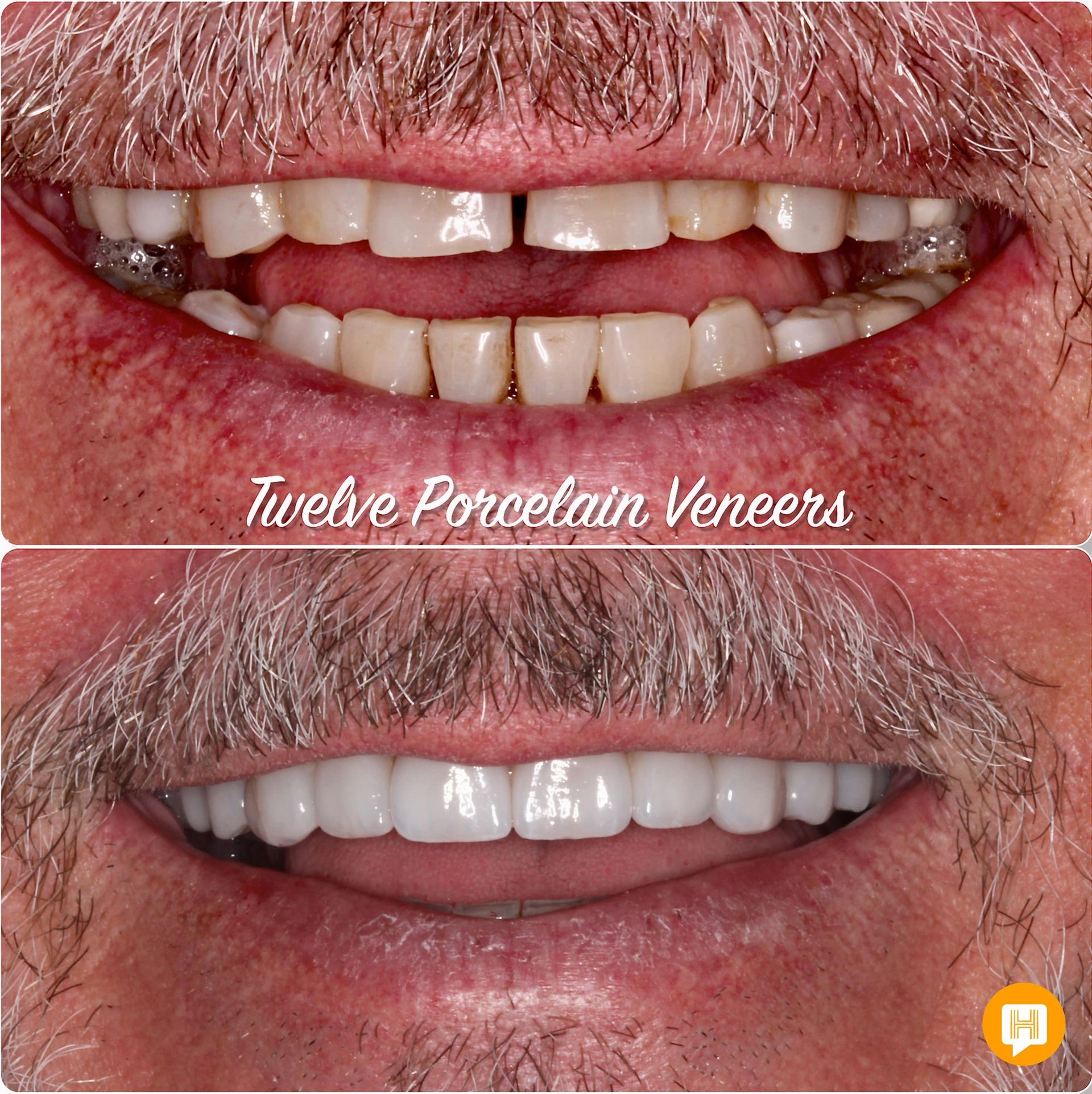 A picture of a man 's teeth before and after porcelain veneers