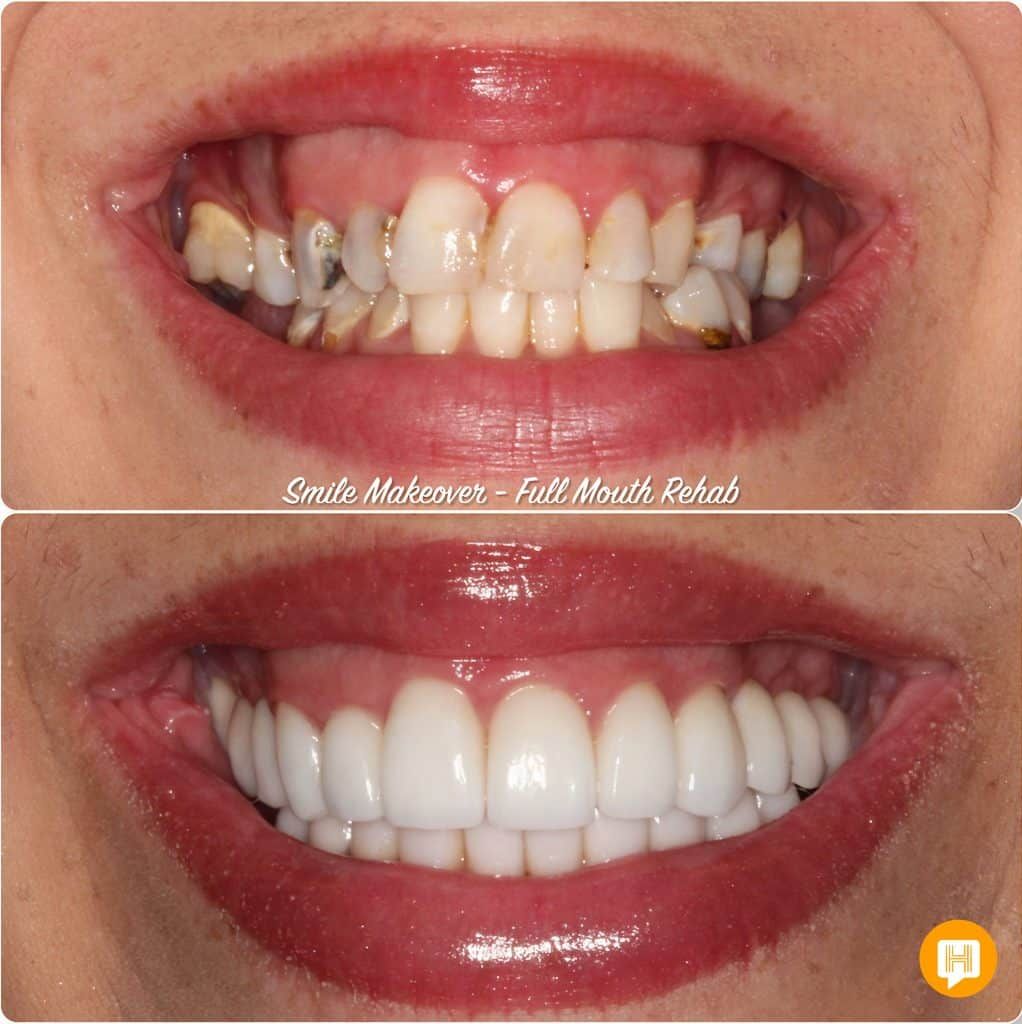 A before and after photo of a woman 's teeth