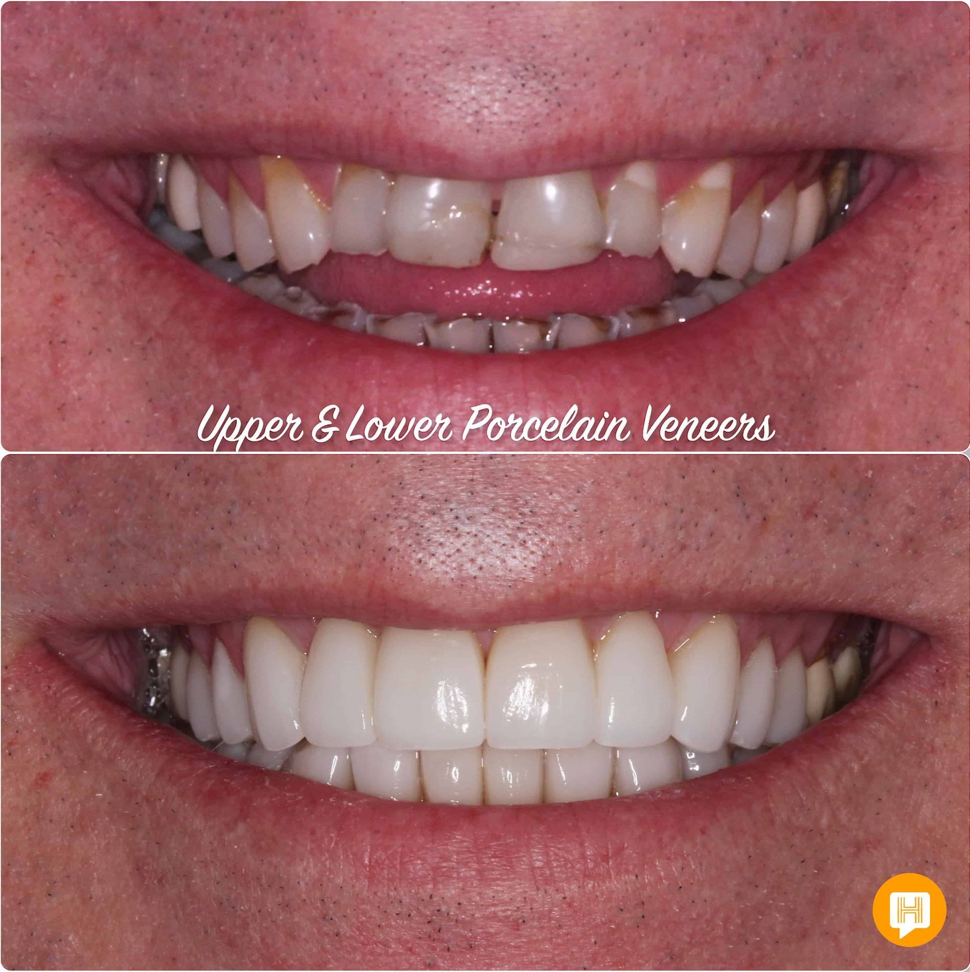 A before and after picture of upper and lower porcelain veneers