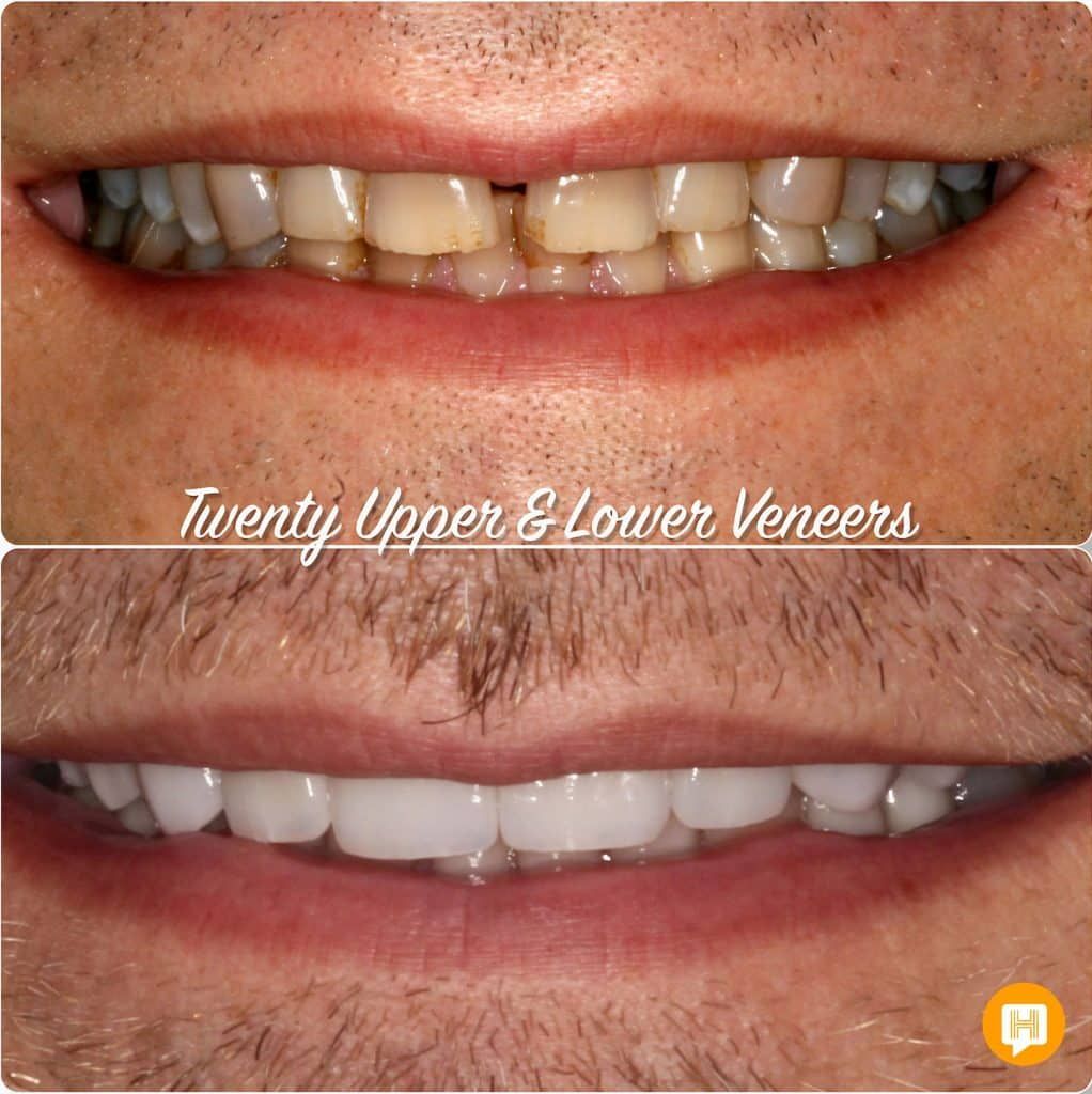 A before and after photo of a man 's teeth with twenty upper and lower veneers