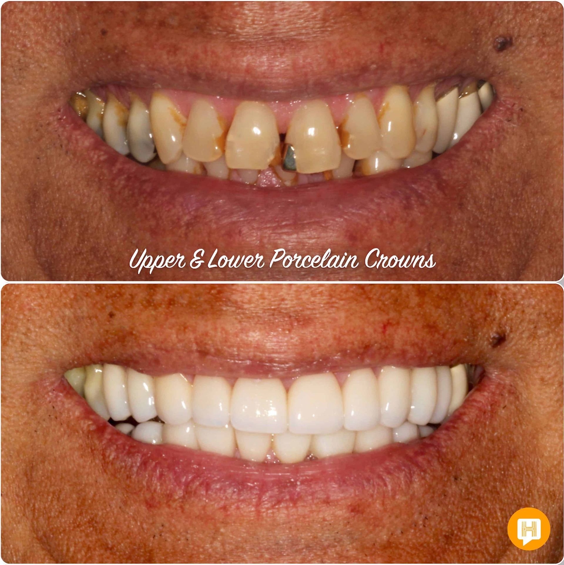 A before and after picture of a person 's teeth with porcelain crowns.