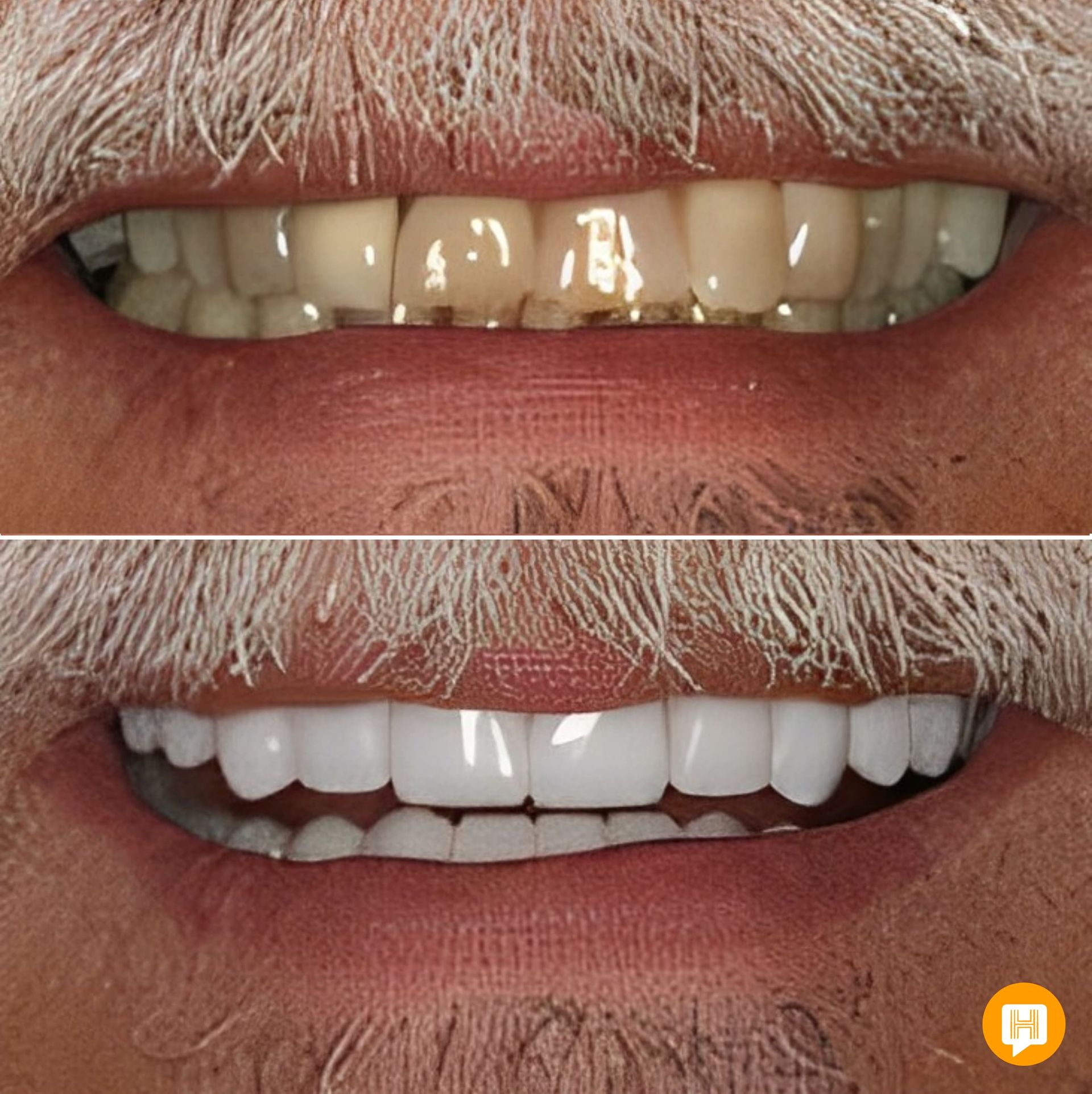 A before and after photo of a man 's teeth.