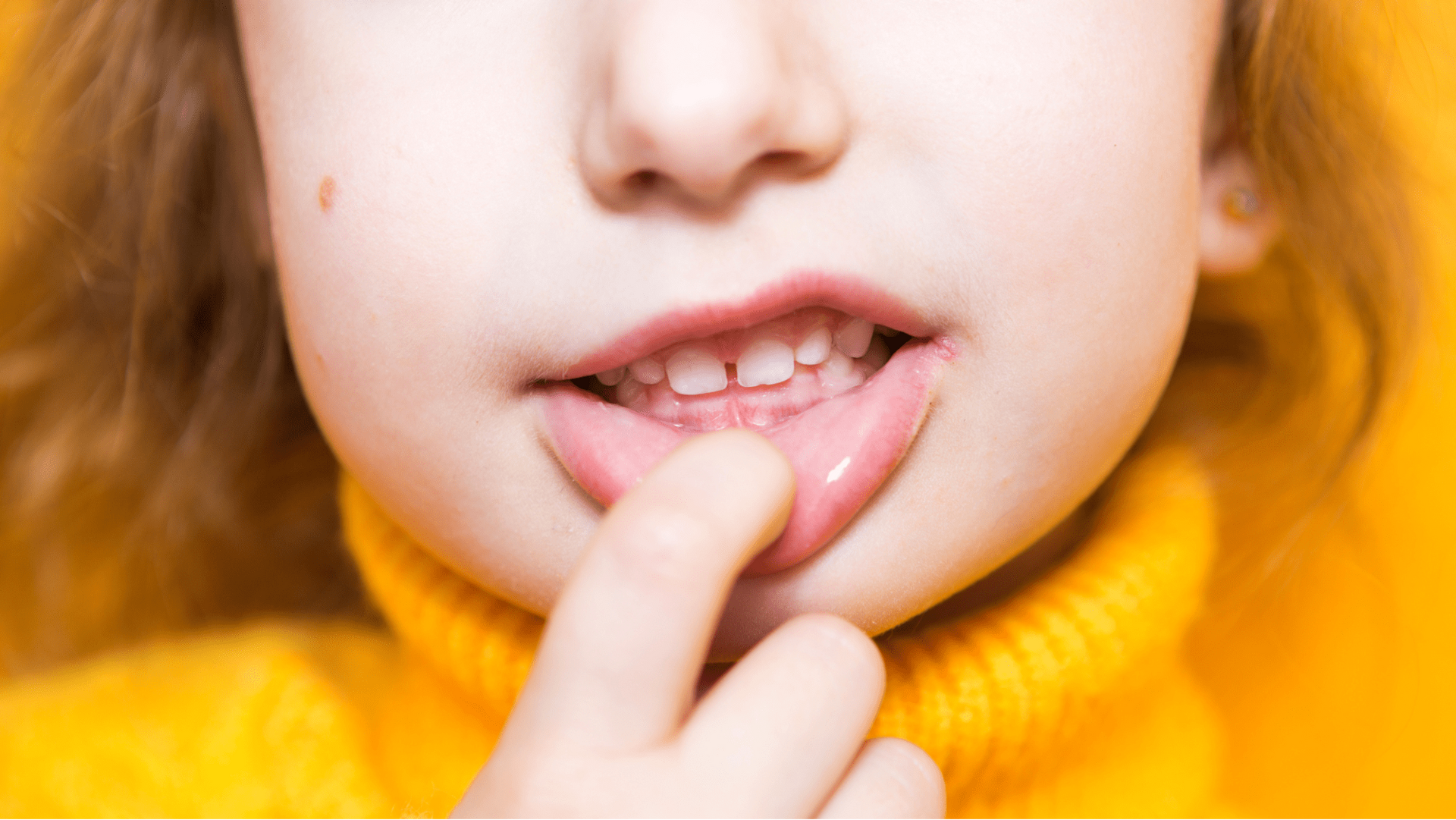 Common Bite Problems in Children and Adults