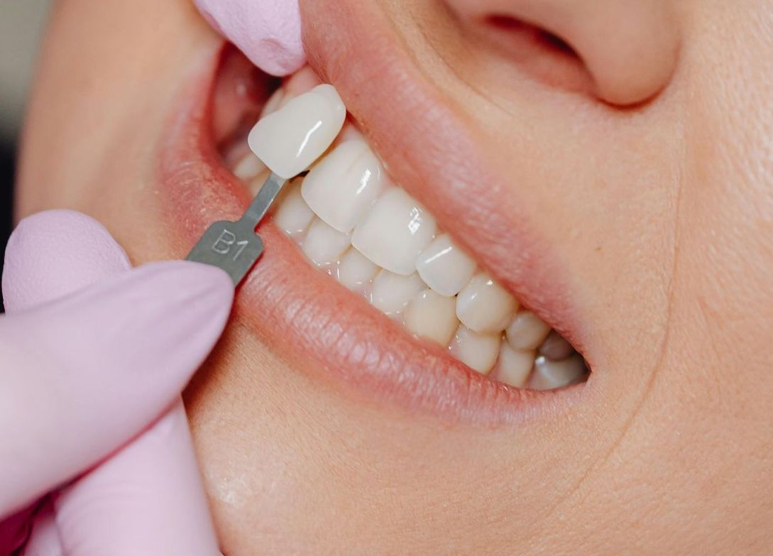 A woman is getting her teeth whitened by a dentist.