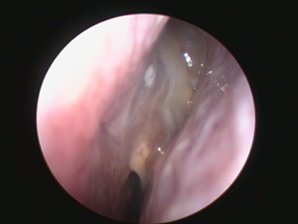 nasal polyps