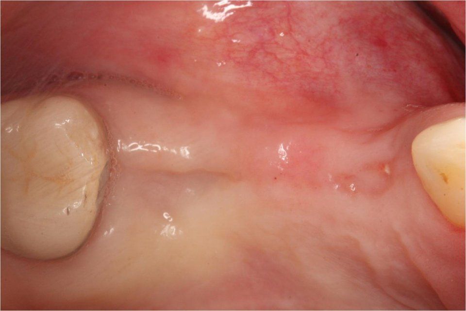 maxillary sinus lift surgery