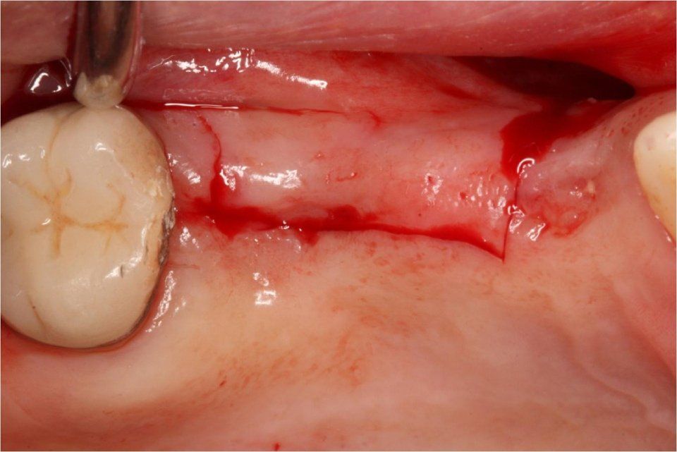 particularly during maxillary sinus lift surgery
