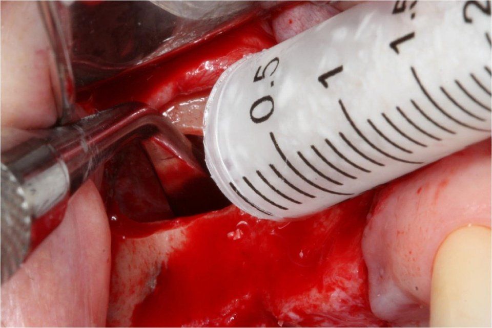 photo taken during maxillary sinus lift surgery