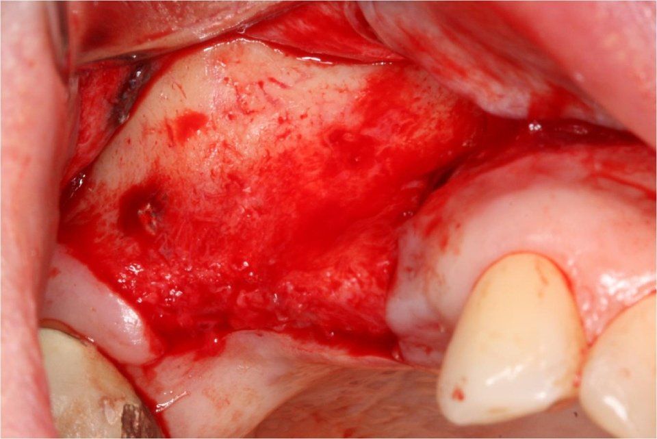photo taken during maxillary sinus lift surgery