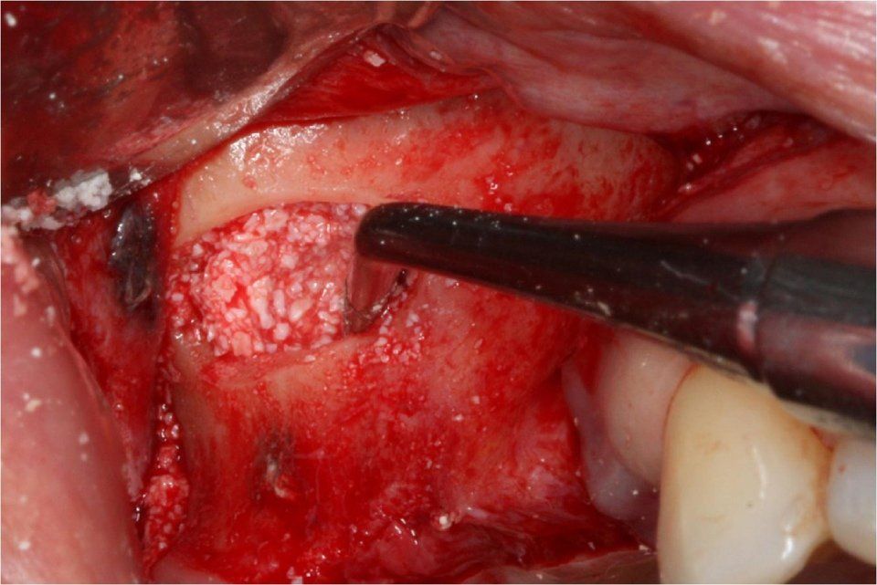 specifications for maxillary sinus lift surgery